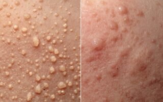 What Is Fungal Acne